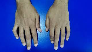 Flexion and Boutonniere Deformities in Rheumatoid Arthritis [upl. by Garmaise]