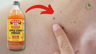 How To Use Apple Cider Vinegar To Remove Warts [upl. by Orelie]