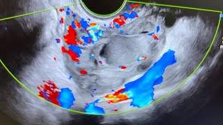 Ultrasound of acute salpingitis thick vascular fallop tube endometriotic simple amp nabothian cyst [upl. by Hannus]