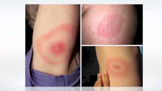 Lyme Disease Pictures  wikiSymptoms [upl. by Warram]