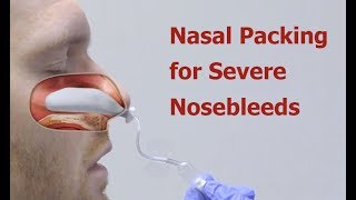 Nasal Packing for Severe Nosebleeds [upl. by Lehctim]