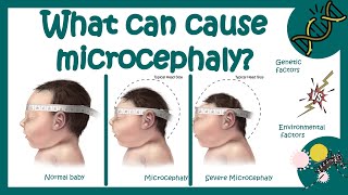 Microcephaly  What is the main cause of microcephaly  What is life expectancy for microcephaly [upl. by Gino10]