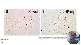 Neuropathology  Part 2 [upl. by Eisor]