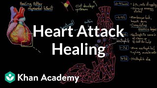 Healing after a heart attack myocardial infarction  NCLEXRN  Khan Academy [upl. by Strage]