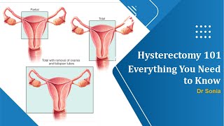 Hysterectomy 101 Everything You Need to Know Before and After the Procedure [upl. by Petrine]