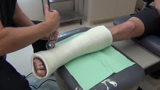 Removing and Bivalving a Cast [upl. by Kary]