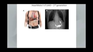 Echocardiography in the Management of Patients with Left Ventricular Assist Devices [upl. by Anyad]