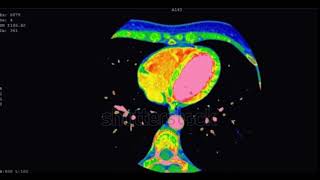 CT scan coronary Angiography [upl. by Ytsim621]