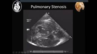 Pulmonary stenosis and pulmonary atresia  Stephen Sanders MD [upl. by Wildee]