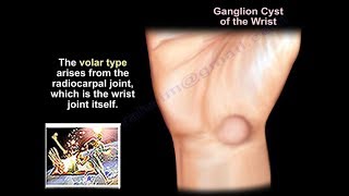 Ganglion Cyst Wrist  Everything You Need To Know  Dr Nabil Ebraheim [upl. by Hendry]