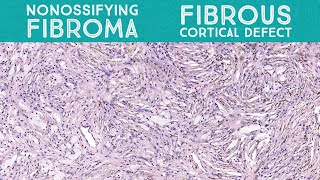 Nonossifying fibroma metaphyseal fibrous defectfibrous cortical defect bone pathology [upl. by Anier]