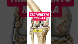 Tratamiento gonartrosis desgaste cartilago rodilla artrosis articulaciones tratamiento dolor [upl. by Esimorp]