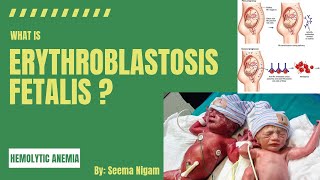 Erythroblastosis FetalisRh incompatibility and Hemolytic disease of the newborn HDN [upl. by Ivatts536]