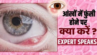 Eye Infection Prevention बरसात के मौसम में आंखों में होती है ये दर्दनाक समस्या जानें इलाज [upl. by Nyvlem]