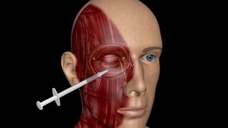 3D MEDICAL TRAINING PROGRAM  BLEPHAROSPASM TREATMENT [upl. by Hadwyn]