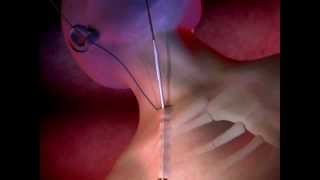 ProGuide™ Chronic Dialysis Catheters Animation [upl. by Lehmann]