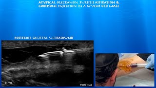 Ultrasound Guided Atypical Olecranon Bursitis Aspiration and Cortisone Injection by probeultrasound [upl. by Joanne]