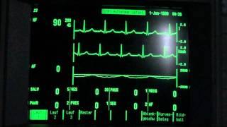 ECG  EKG paroxysmal supraventricular tachycardia holiday heart syndrome vs sick sinus syndrome [upl. by Floridia364]