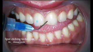 Spot Etching Technique for provisional dental Veneers [upl. by Ecal30]