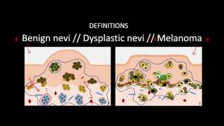 Introduction to Skin Cancer 3 Overview of Nevi and Melanoma [upl. by Adnamar]