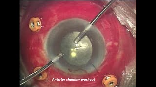 Endophthalmitis After Cataract Surgery Khaled A Shalaby MD [upl. by Hakaber]