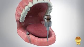 TAG Angulated Multi Unit Abutment System [upl. by Ainegue]