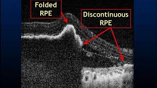 RPE Rip Noninvasive detection [upl. by Naara]