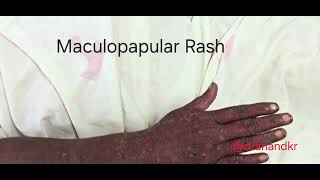 maculopapularrash rash dengue denguevirus dengueawareness denguefeversymptoms denguesituation [upl. by Katine]