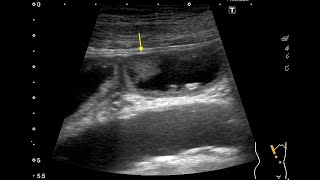 gallbladder cancer [upl. by Seale]