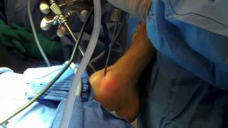 Ankle Arthroscopy [upl. by Fairbanks]