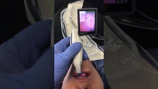 Video Laryngoscopy [upl. by Hsaniva]