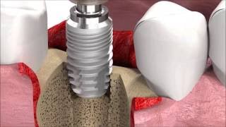 SIC invent Dental Implant Procedure SICmax implant insertion [upl. by Labaw129]