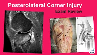 Posterolateral Corner Injuries Exam Review  Raymond Kim MD [upl. by Ahsiel]