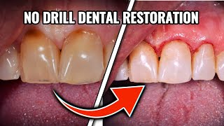 82 No Prep Esthetic Restorations 11B 21B 22B [upl. by Delaryd]