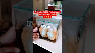 Fibroid uterus  बच्चेदानी की गाँठ । Uterine myoma [upl. by Stacy]