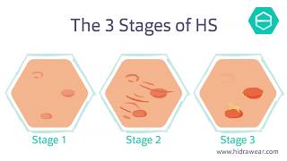 The stages of Hidradenitis Suppurativa [upl. by Zingale]