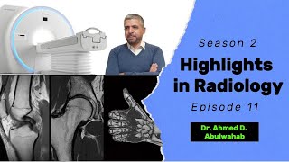 Highlights in Radiology S2 E11 Aneurysmal bone cyst ABC [upl. by Aicel]