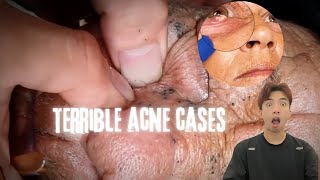 The MOST TERRIFYING Acne Squeezing Videos Youve Ever Seen 1 [upl. by Lana171]