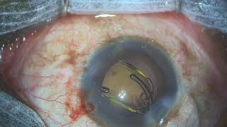 OphtalmoPro  implantation lentille intraoculaire PrimusHD incision 20 mm [upl. by Pomfret]