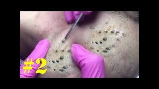 How To Removal Blackhead And How To Get Rid Of Blackhead Blackhead On Face 3 [upl. by Naujuj]