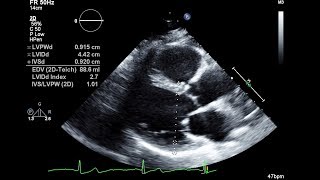 Routine Echocardiogram Protocol With Standard 2D Echo Images and Color Doppler [upl. by Afatsom]