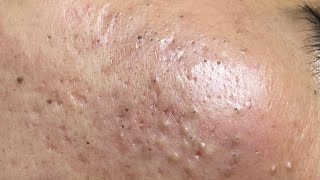 ACNE TREATMENT VU QUYNH MI  Blackheads On Boy Face 2024FULL [upl. by Ahsimrac]