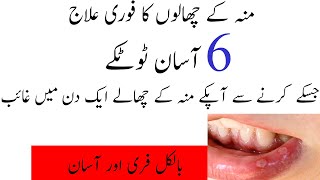 Munh Ke Chalon Ka fori Ilaj Mouth Blister [upl. by Bel]