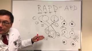 RAPD Relative Afferent Pupillary Defect MarcusGunn pupil [upl. by Kirstyn]