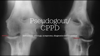 Pseudogout  CPPD Calcium pyrophosphate deposition disease Essential medicine [upl. by Zildjian667]