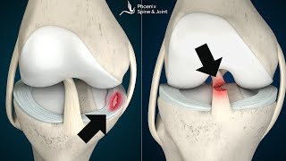 Is your knee pain coming from an ACL tear or Meniscus injury How to tell [upl. by Manella377]