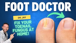 5 EASY TOENAIL FUNGUS HOME TREATMENTS FROM FOOT DOCTOR  2024 [upl. by Lal851]