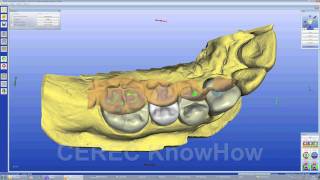 CEREC® Bridge Biogeneric Reference  Bridge  Software [upl. by Peacock]