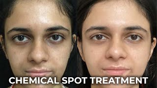 The Secret to Flawless Skin  Chemical Spot Treatment [upl. by Nosam]