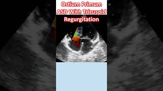 Ostium Primum ASD With Tricuspid Regurgitation [upl. by Lenuahs]